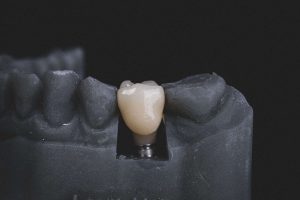Szczecin implanty zębów